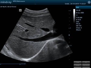 MTG Z60 Abdomen